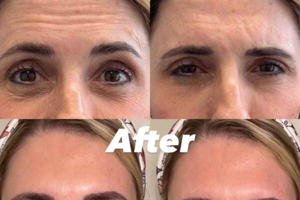 neurotoxin-1 neurotoxin-1