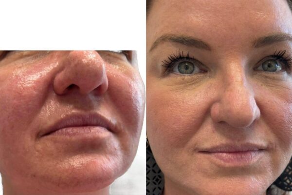 Morpheus8-14 A woman's face before and after RF microneedling in St. Louis.