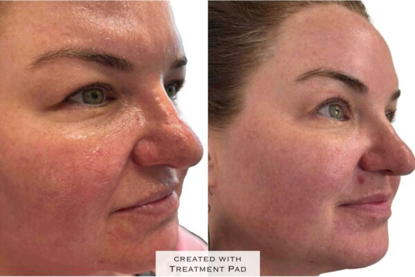 Morpheus8-15 A woman's face before and after RF microneedling in St. Louis.
