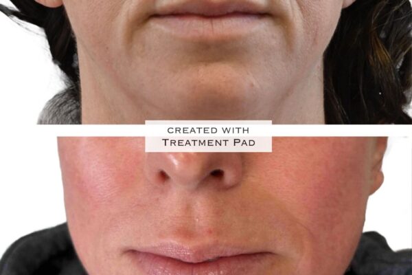 Morpheus8-19 A woman's lower face before and after RF microneedling in St. Louis.