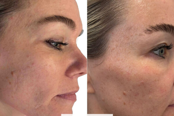 morpheus8-10 A woman's face before and after RF microneedling in St. Louis.