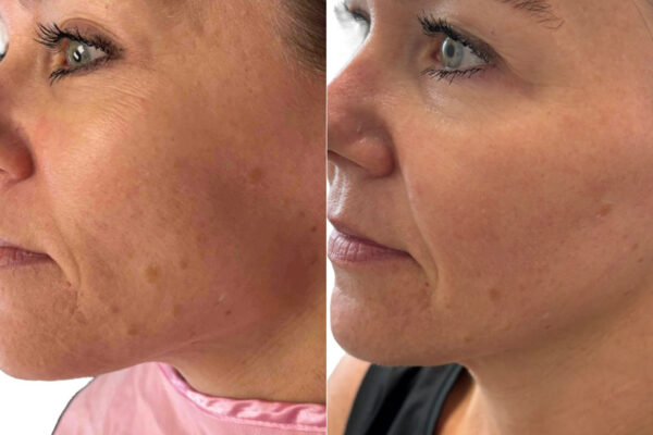morpheus8-11 A woman's face before and after RF microneedling in St. Louis.