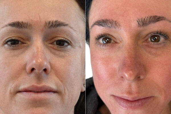 morpheus8-12 A woman's face before and after RF microneedling in St. Louis.