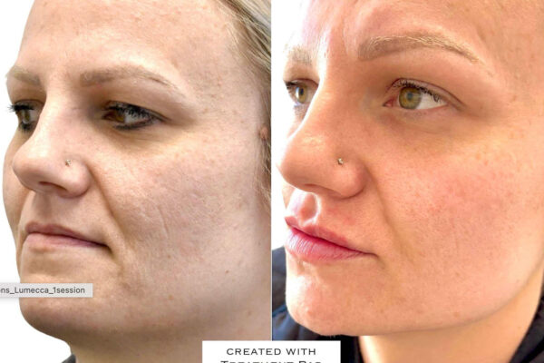 morpheus8-2 morpheus8-2