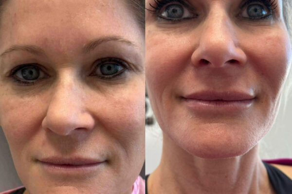 morpheus8-3 morpheus8-3