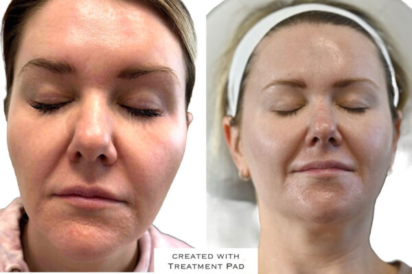 morpheus8-4 A woman's face before and after RF microneedling in St. Louis.