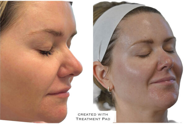 morpheus8-5 A woman's face before and after RF microneedling in St. Louis.