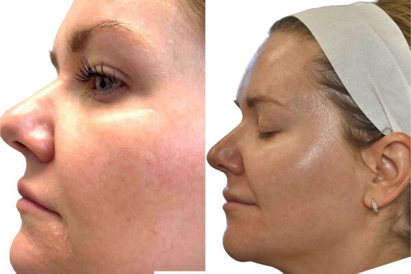 morpheus8-6- A woman's face before and after RF microneedling in St. Louis.