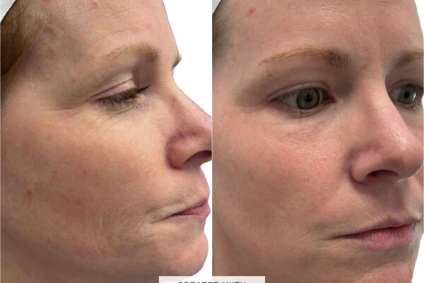morpheus8-7 A woman's face before and after RF microneedling in St. Louis.