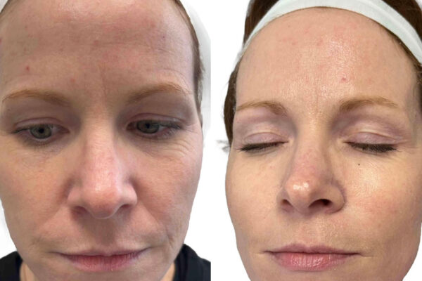 morpheus8-8 A woman's face before and after RF microneedling in St. Louis.