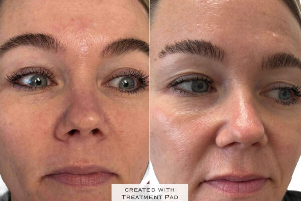 morpheus8-9 A woman's face before and after RF microneedling in St. Louis.