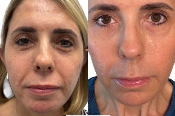 neurotoxins-4 neurotoxins-4